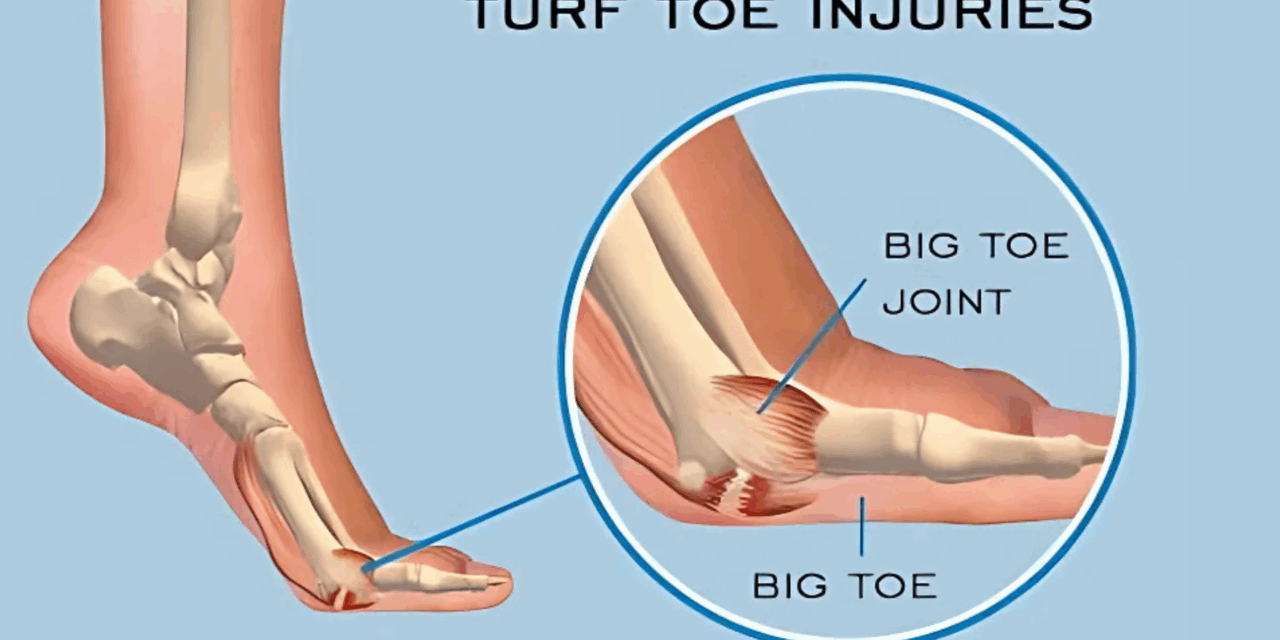 What is Turf Toe: Understanding, Prevention, and Treatment
